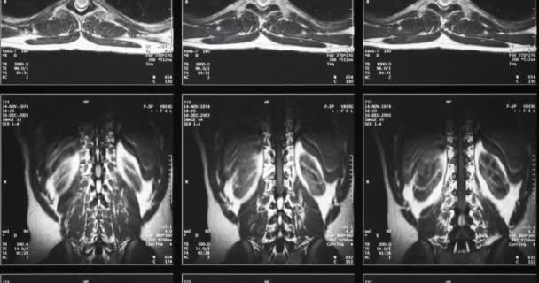 Radiografia Médica Raio-X de um tronco humano - Filmagem, Vídeo
