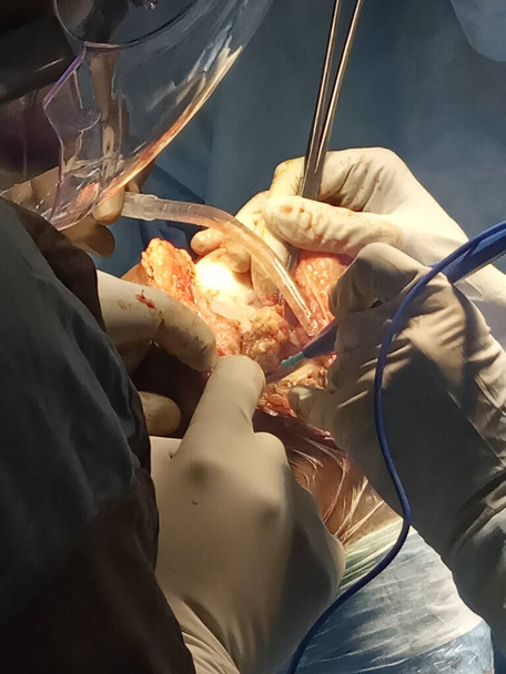 Cirugía de tórax haciendo por médicos asiáticos en sala de OT - Foto, Imagen