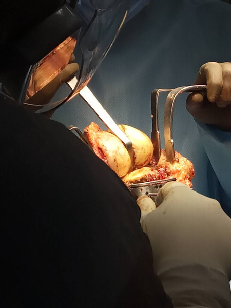 chirurgia delle ossa del ginocchio in corso con il supporto di strumenti medici da parte di medici ospedalieri - Foto, immagini