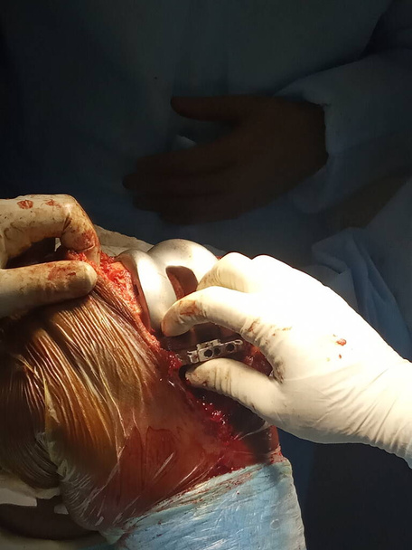 Operation der Fußknochen durch indische Chirurgen - Foto, Bild