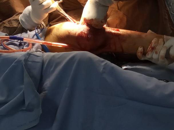Vahingossa jalka leikkaus tekee lääkäri OT huoneessa - Valokuva, kuva