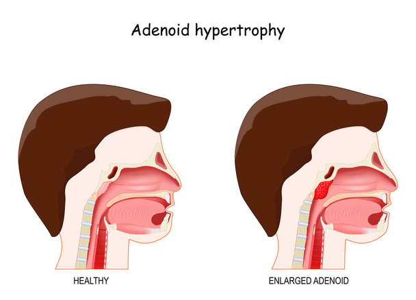 Adenoid-Hypertrophie. Querschnitt des menschlichen Kopfes mit gesunden und entzündungsvergrößerten Adenoiden. Vektorillustration - Vektor, Bild