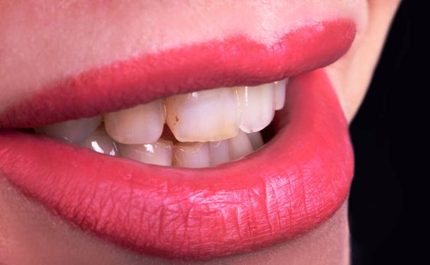  Nahaufnahme Schmutzige krumme gelbe Zähne junge Frau lächelt, sinnliche weibliche dicken Lippen Frau lächeln. Zahnersatzchirurgisches Konzept. Gesundheitszahnarzt-Konzept - Foto, Bild