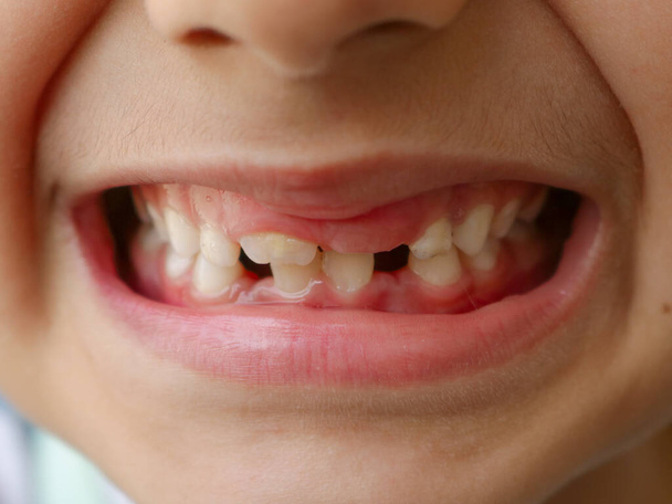 Ребенок со сломанными зубами, пробелы в зубах, пространство между зубами - Фото, изображение