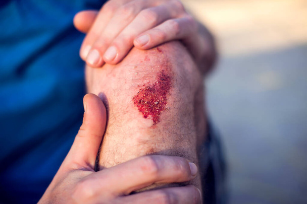 Επείγον ατύχημα ανοιχτό γδάρσιμο τραύμα τραύμα στο πόδι γόνατο. Άνθρωποι, υγειονομική περίθαλψη και ιατρική έννοια - Φωτογραφία, εικόνα