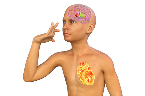 Poika, jolla on Sydenhamin korea ja käden tahattomat liikkeet, 3D-kuva. Autoimmuunisairaus Streptococcus-infektion jälkeen aivojen tyvisolujen ja sydämen vasta-aineiden vuoksi - Valokuva, kuva
