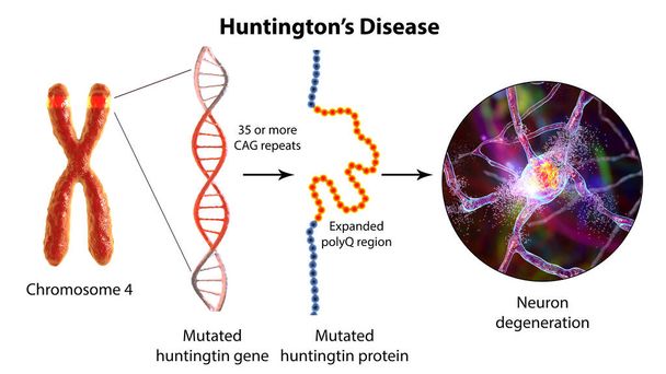 Молекулярная генетика болезни Хантингтона, трехмерная иллюстрация. Расширение последовательности тринуклеотидов CAG в гене htt приводит к образованию мутировавшего белка Хантингтина, ведущего к нейродегенерации. - Фото, изображение