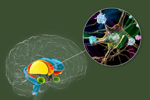 Estrato dorsal y sus neuronas en la enfermedad de Huntington, ilustración 3D que muestra cuernos anteriores agrandados de ventrículos laterales, degeneración y atrofia del estrato dorsal, inclusiones neuronales - Foto, Imagen