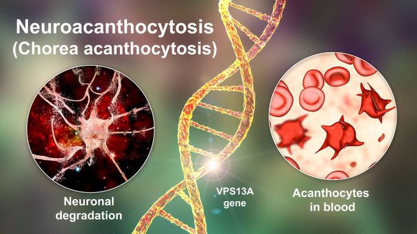 Neuroacanthocytosis, Chorea acanthocytosis, μια νευροεκφυλιστική ασθένεια λόγω μετάλλαξης στο γονίδιο VPS13A, χαρακτηρίζεται από την παρουσία των ακανθοκυττάρων σε κινήσεις του αίματος και χοροειδών, 3D εικονογράφηση - Φωτογραφία, εικόνα