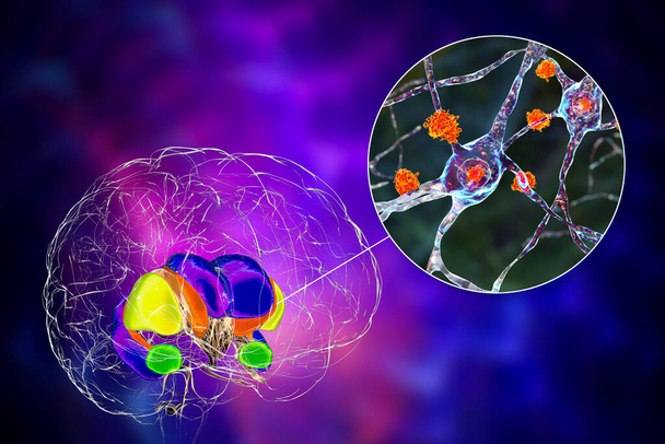 Дорсальная стриатум и его нейроны при болезни Хантингтона, 3D иллюстрация, показывающая увеличенные передние рога боковых желудочков, дегенерацию и атрофию дорсальной стриатумы, включения нейронов - Фото, изображение