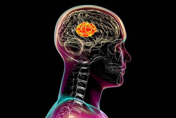 Gehirnschleimhaut, eine durch Pilze verursachte Hirnläsion Mucor, auch als schwarzer Pilz bekannt, 3D-Illustration - Foto, Bild