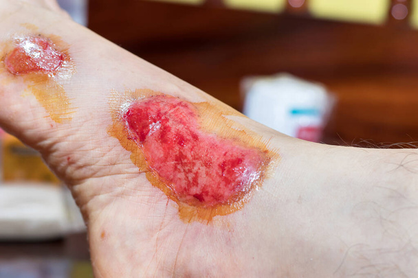 Свежие волдыри крови на ногах женщин, отражение и побочный эффект от травмы от поражения мотоцикла - Фото, изображение