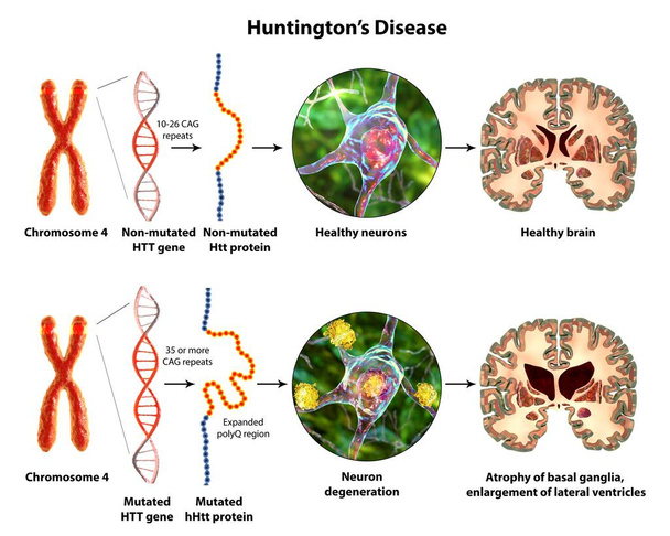 Huntingtonin taudin molekyylituotanto, 3D-kuvitus. CAG-trinukleotidisekvenssin laajeneminen htt-geenissä aiheuttaa mutatoituneen Huntingtin-proteiinin tuotannon, joka johtaa neurodegeneraatioon - Valokuva, kuva