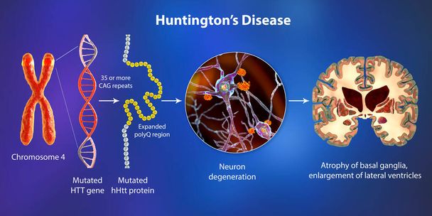Molekularna geneza choroby Huntingtona, ilustracja 3D. Rozbudowa sekwencji trinukleotydów CAG w genie htt powoduje wytwarzanie zmutowanego białka Huntingtin prowadzącego do neurodegeneracji - Zdjęcie, obraz