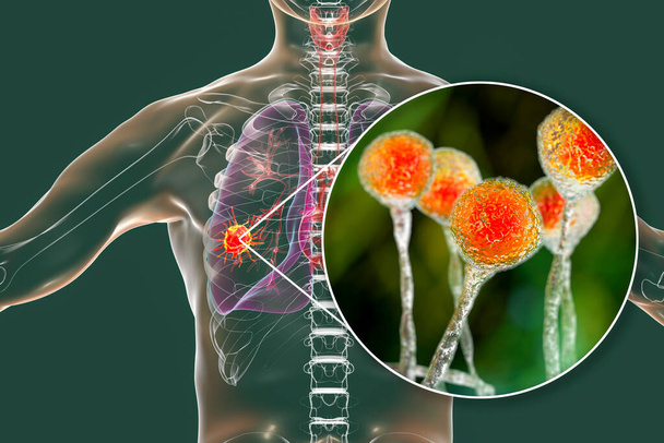 Mucormicosis pulmonar, una enfermedad pulmonar causada por hongos Mucor, también conocido como hongo negro, con vista cercana de los hongos, ilustración 3D. Complicación de Covid-19 - Foto, Imagen