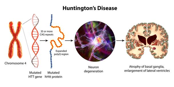 ハンティントン病の分子発生、 3Dイラスト。ht遺伝子におけるCAG三核酸配列の拡大は、変異したハンチンチンタンパク質の産生を引き起こし、神経変性を引き起こす。 - 写真・画像