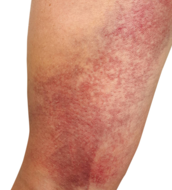 leg big bruise isolated on white background - Foto, Imagen