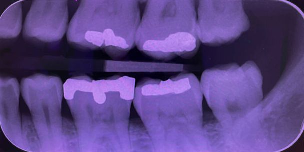 Рентген зубов показал корни зубов и пломбы амальгамы.. - Фото, изображение