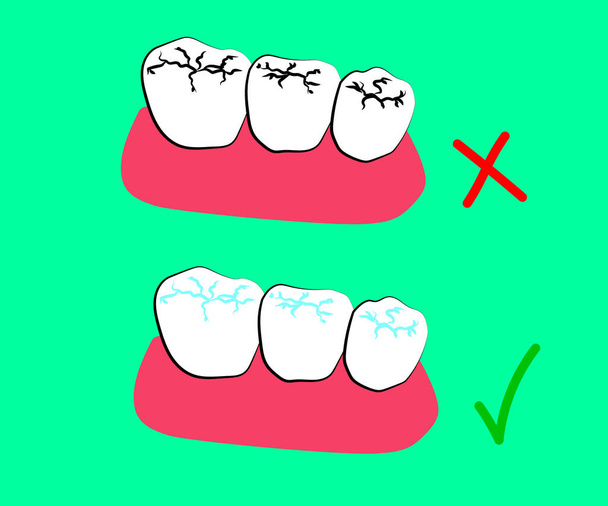 Human molars. Caries and filling. Cartoon. Vector illustration. - Vector, Image
