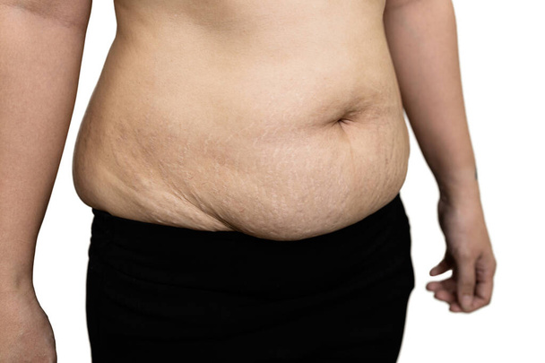 Gruba kobieta z pasiastym brzuchem, rozstępy i blizny na brzuchu po ciąży, problemy poporodowe, nadmiar tłuszczu i zwiotczała skóra na dużym brzuchu, brzuszna warstwa tłuszczu, wybrzuszenie żołądka, koncepcja pielęgnacji skóry - Zdjęcie, obraz