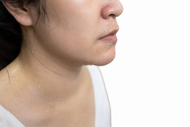 Overheated lady girl with sweaty skin on the face,excessive sweating,water droplets of sweat on her nose,mouth and body from hot summer weather,perspiration and rapid heartbeat,hyperhidrosis disease - Photo, Image