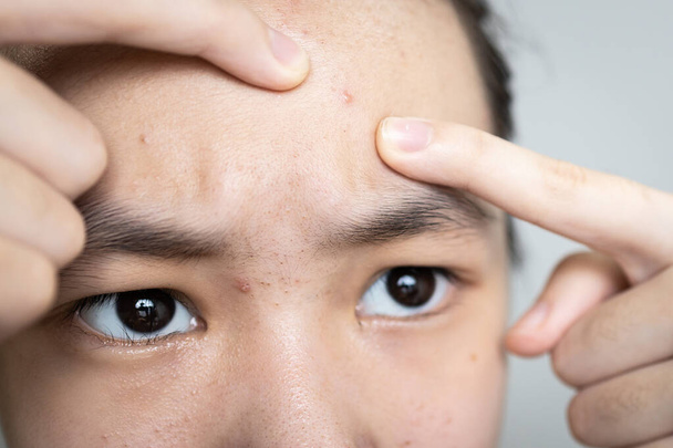 Azjatycka nastolatka wyciskając pryszcze z palcami na czole, wyskakując pryszcz na twarzy, zatyczka sebum w mieszku włosowym powoduje trądzik, odmładzanie skóry, leczenie trądziku, pielęgnacja twarzy i pielęgnacja skóry twarzy - Zdjęcie, obraz