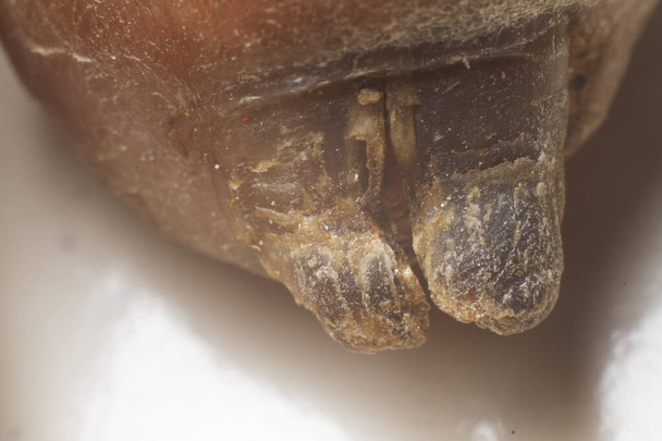 Μόλυνση από μύκητες στα νύχια του αντίχειρα μιας γριάς. κλείνει. - Φωτογραφία, εικόνα