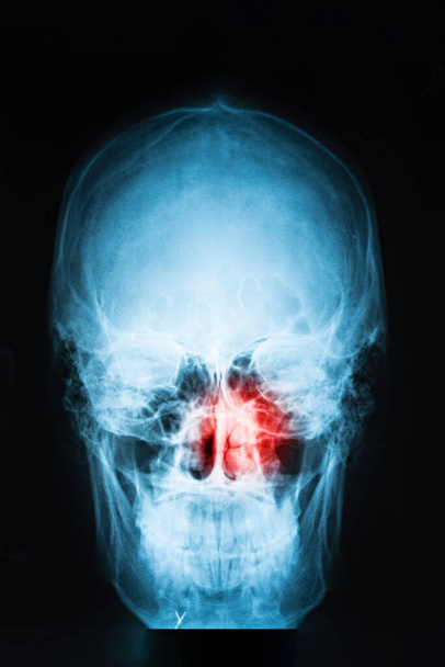 x-ray image of skull with red pain point in sinuses, sinusitis concept, vertical, closeup - Photo, Image