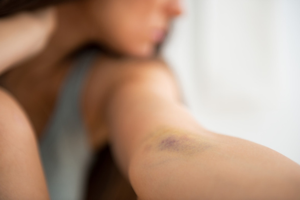Drug addict woman with bruise on hand - Foto, afbeelding