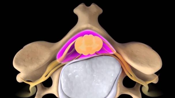 La estenosis espinal como una enfermedad degenerativa en las vértebras humanas que causa la compresión de los nervios de la columna vertebral concepto médico como una ilustración 3D. - Foto, imagen