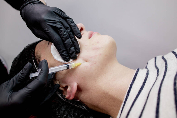 Cosmetologist doctor is making multiple injections biorevitalization with hyaluronic acid in woman face skin, closeup. Woman on the procedure of mesotherapy injection. - Zdjęcie, obraz