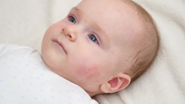Ritratto di piccolo bambino carino con pelle rossa che soffre di acne o dermatite. Concetto di igiene del neonato, salute e cura della pelle - Filmati, video