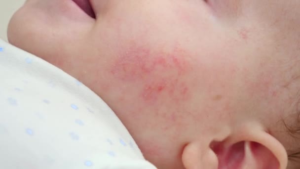 Primer plano de la cara del bebé con la piel roja que sufre de acné y dermatitis. Concepto de higiene del bebé recién nacido, salud y cuidado de la piel - Metraje, vídeo