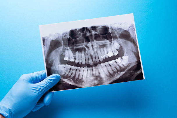Un dentista que sostiene la instantánea del diente de los pacientes e indica el problema. Imagen panorámica de la mandíbula sobre un fondo azul aislado. - Foto, imagen