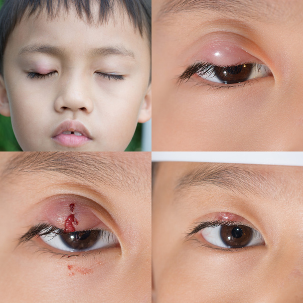目のふた膿瘍"麦粒腫" - 写真・画像