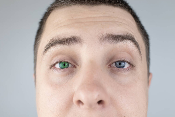 色目の違う男がフレームを覗き込む。右目は青、左目は緑です。ヘテロクロミア。遺伝子変異。多色の目. - 写真・画像