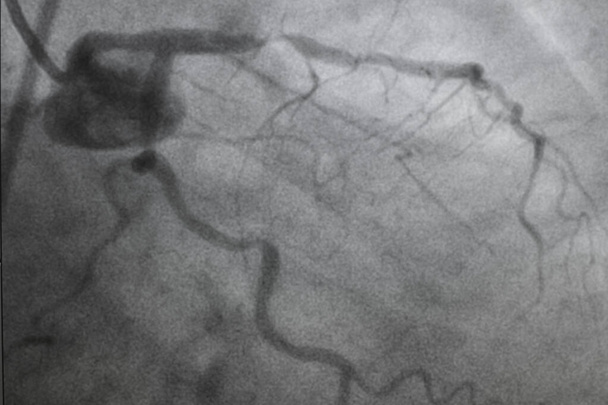 Coronaire angiografie, coronaire hartziekte. Medische röntgenfoto van hartziekten. Gezondheidszorg en medisch concept. - Foto, afbeelding