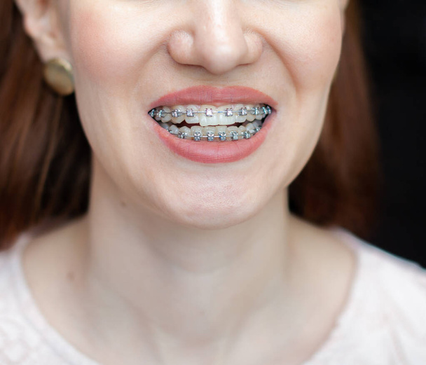 De glimlach van een jong en mooi meisje met beugels op haar witte tanden. Rechtop zetten van kromme tanden met behulp van een beugelsysteem. Malocclusie. Tandheelkundige zorg. Gladde tanden en een mooie glimlach - Foto, afbeelding