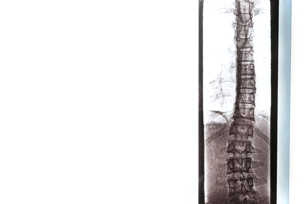 Ακτινογραφία των οστών του πίσω μέρους των σπονδύλων, των πνευμόνων και του θώρακα σε περίπτωση σκολίωσης και καμπυλότητας της σπονδυλικής στήλης - Φωτογραφία, εικόνα
