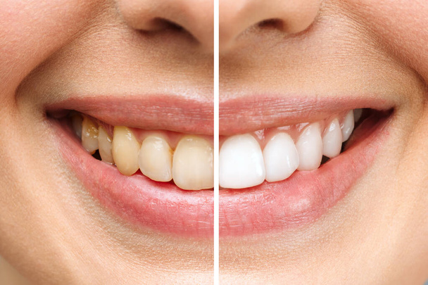 γυναικεία δόντια πριν και μετά τη λεύκανση. Πάνω σε λευκό φόντο. Ασθενής οδοντιατρικής κλινικής. Η εικόνα συμβολίζει την οδοντιατρική φροντίδα του στόματος, την στοματολογία. - Φωτογραφία, εικόνα