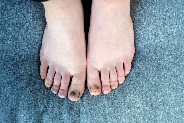 vrouwelijke voeten met 'subunguaal hematoom', zwarte teennagels veroorzaakt door trauma na een watking 30 mijl. - Foto, afbeelding