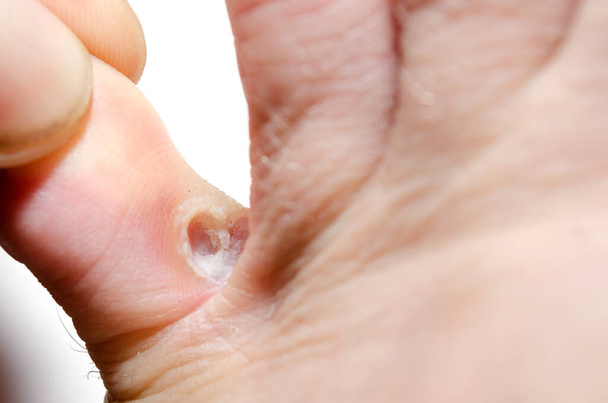 Грибковая инфекция между пальцами ног взрослого мужчины вблизи - Фото, изображение