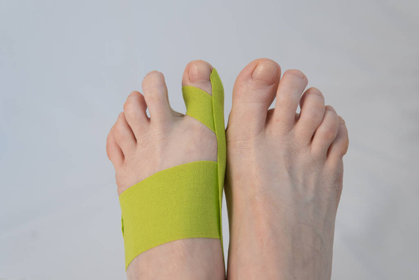 Feet close-up, top view. There is a tap on the big toe. Correction of finger deformity. Hallux valgus. Innovative medicine - Fotó, kép