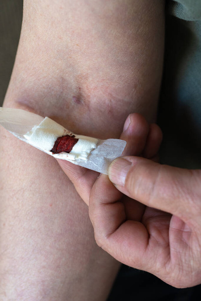 ferida após um procedimento médico, retirando sangue de uma veia - Foto, Imagem