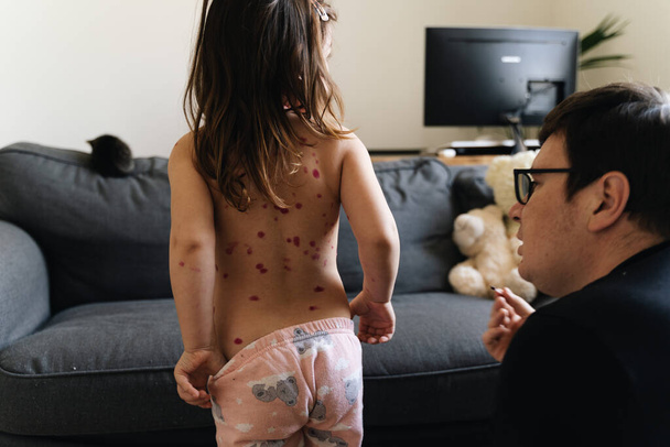 Toddler girl with chickenpox measles on the body. Varicella virus childhood contagious disease. Itchy red blisters, fever, pain symptoms.  - Фото, зображення