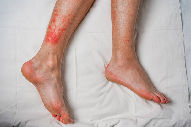 Αρσενικό πόδι, φαγούρα και κόκκινο εξάνθημα που προκαλείται από τσιμπήματα εντόμων και δαγκώματα. Υγεία και ιατρική παρακολούθηση και ανάπτυξη ιδεών. - Φωτογραφία, εικόνα