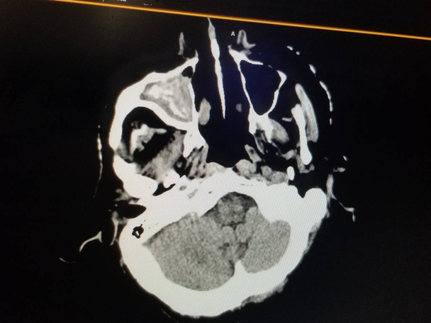 Tomografía computarizada coronal de los senos paranasales Sinusitis maxilar derecha - Foto, Imagen