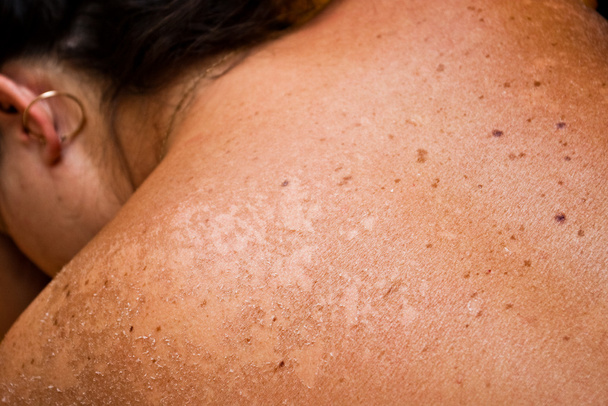 sunburned skin - Foto, Imagem