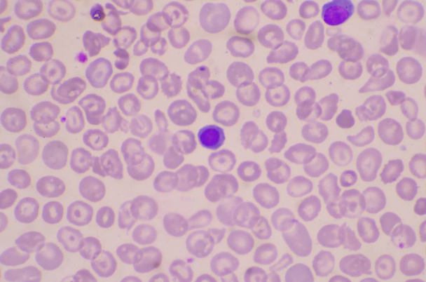 Nuklelowane krwinki czerwone (NRC) w rozmazie krwi. - Zdjęcie, obraz