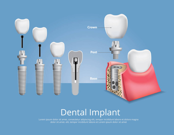 人間の歯と歯科インプラントベクトルイラスト - ベクター画像